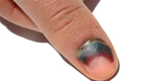 fingernail injury pictures.